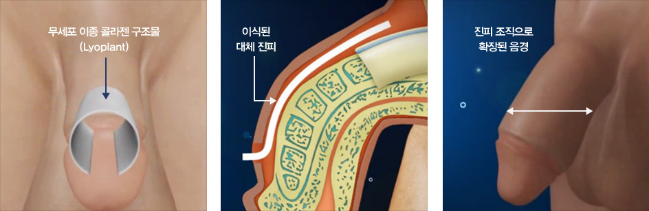 무세포 이종 콜라젠 구조물, 이식된 대체진피, 진피 조직으로 확장된 음경