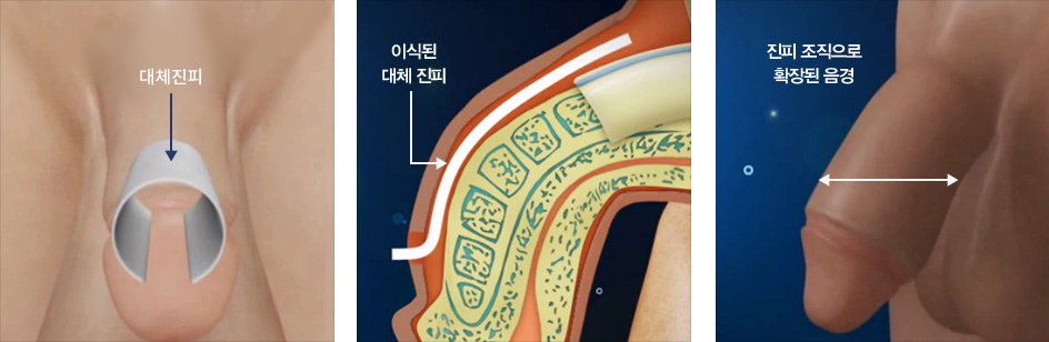 무세포 이종 콜라젠 구조물, 이식된 대체진피, 진피 조직으로 확장된 음경